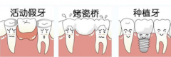 牙冠VS种植牙，谁的修复效果更好？Camlog科美勒告诉您